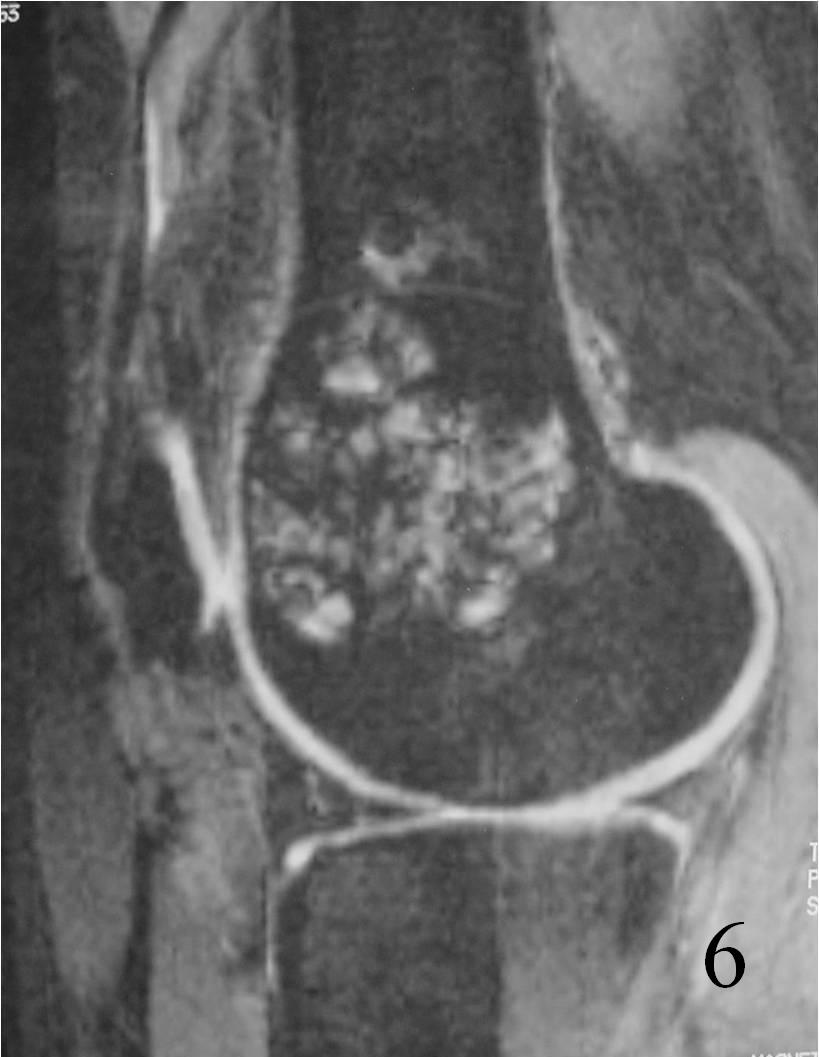 Giant Cell Tumor Of Bone Bone Tumors